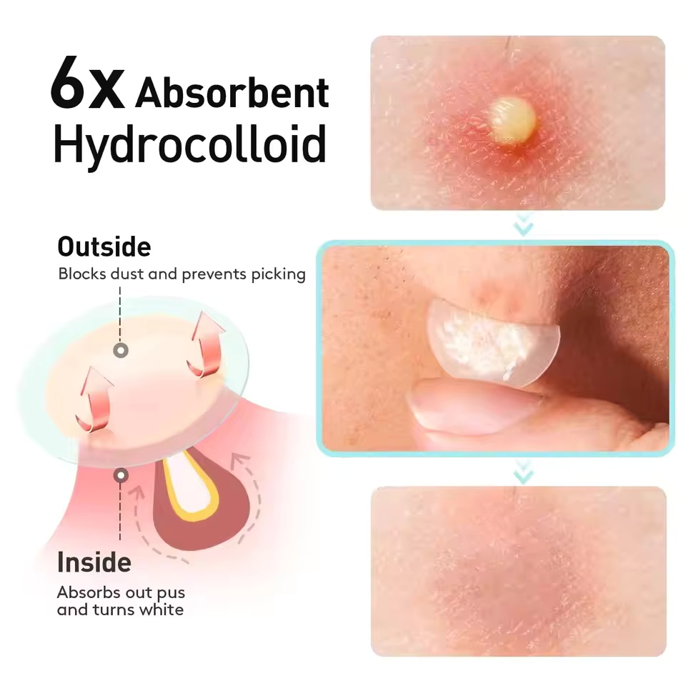 360 adet/kutu akne bantları -  - Face Oil incelemesi ve fiyatı